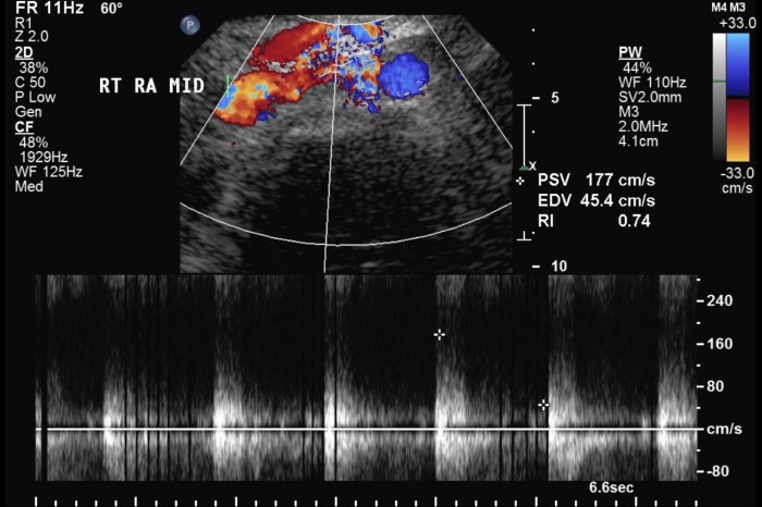 Coding catheterization cpt americanmedicalcoding