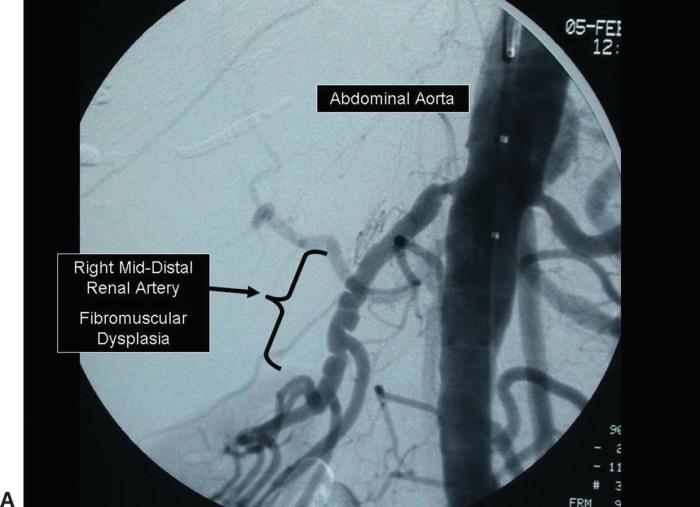 Renal artery duplex cpt code