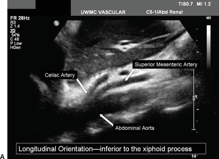 Cpt percutaneous coronary pci intervention coding cco